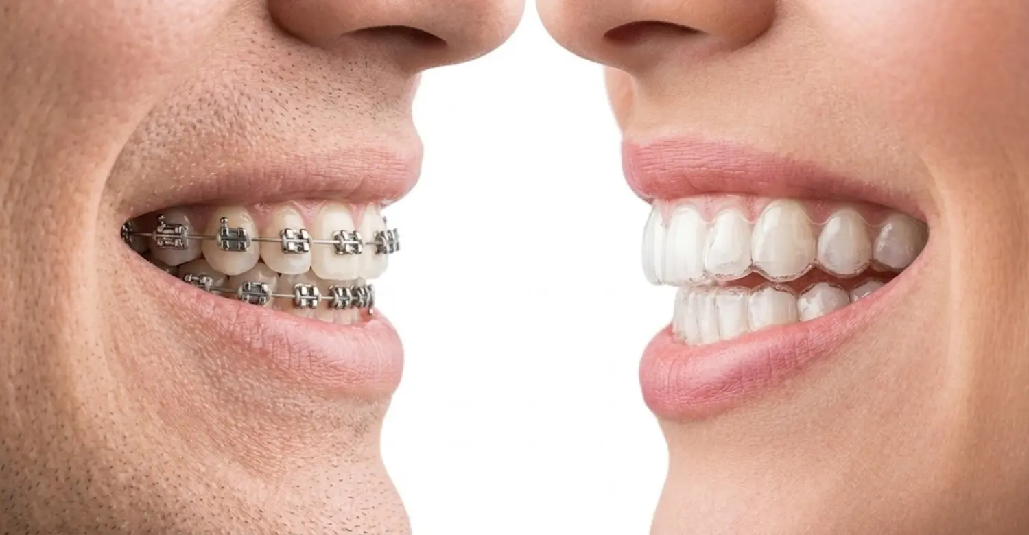 Orthodontics Myths 2